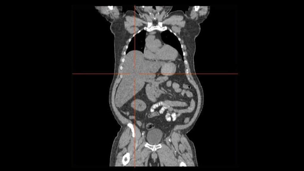 A CT scan image showing severe hepatomegaly extending down to the left side of the abdomen.