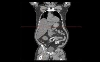 Liver and Causes of Hepatomegaly