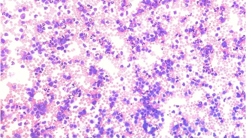 Persistent monocytosis (high monocytes) is seen in the peripheral blood smear of chronic myelomonocytic leukemia.