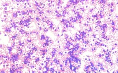 Monocytosis (High Monocytes)