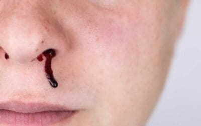 Bernard-Soulier Syndrome