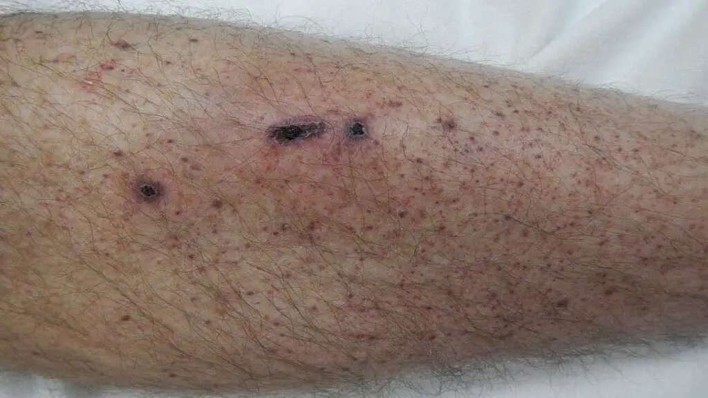 Appearance of petechiae in the lower limb due to immune thrombocytopenia.