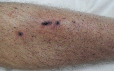 Petechiae