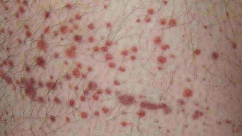 Purpura spots