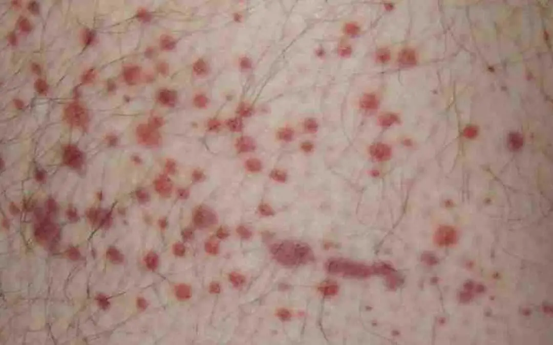 Purpura