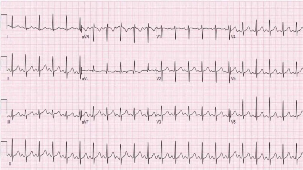 An ECG reading showing sinus tachycardia at 132 beats per minute