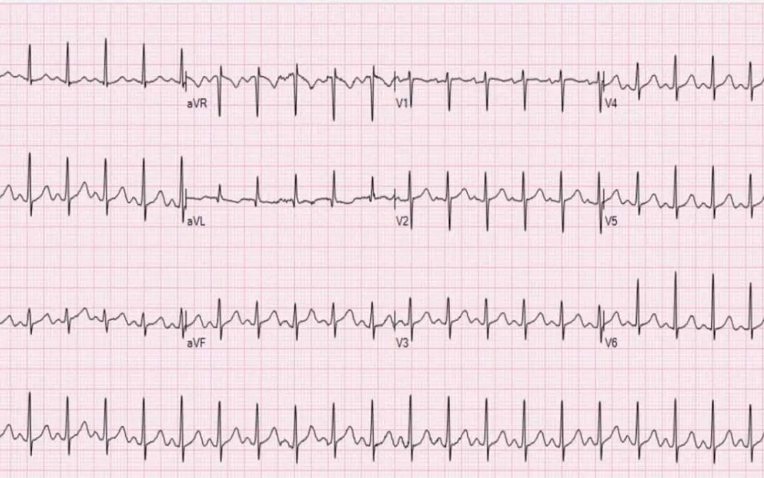 Tachycardia in Hematological Patients