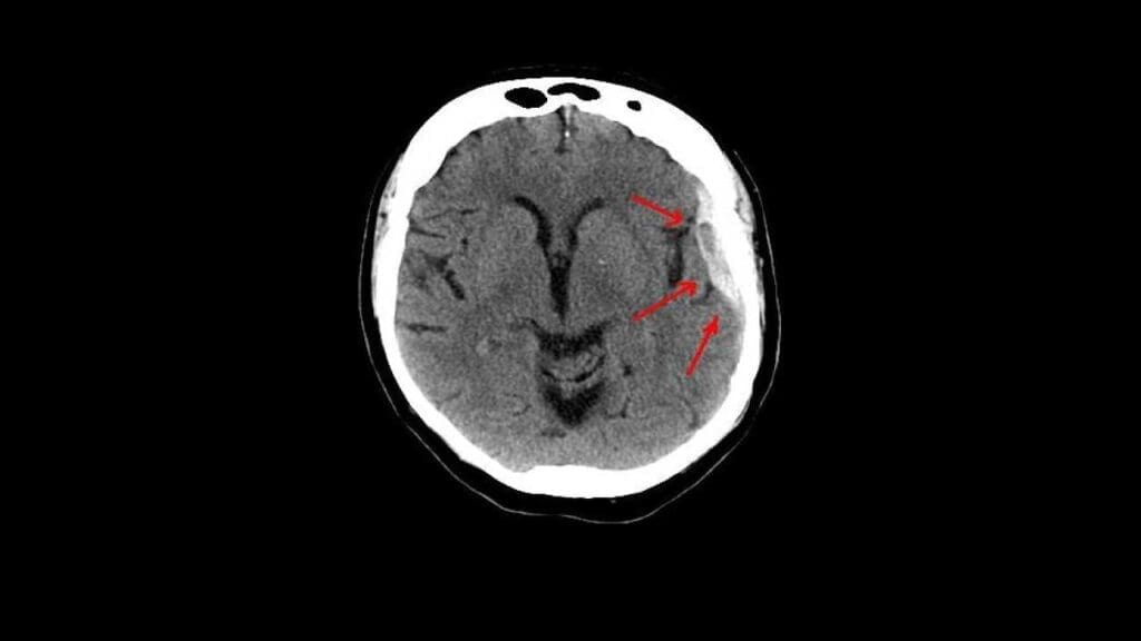 A CT scan of a brain with subdural hematoma