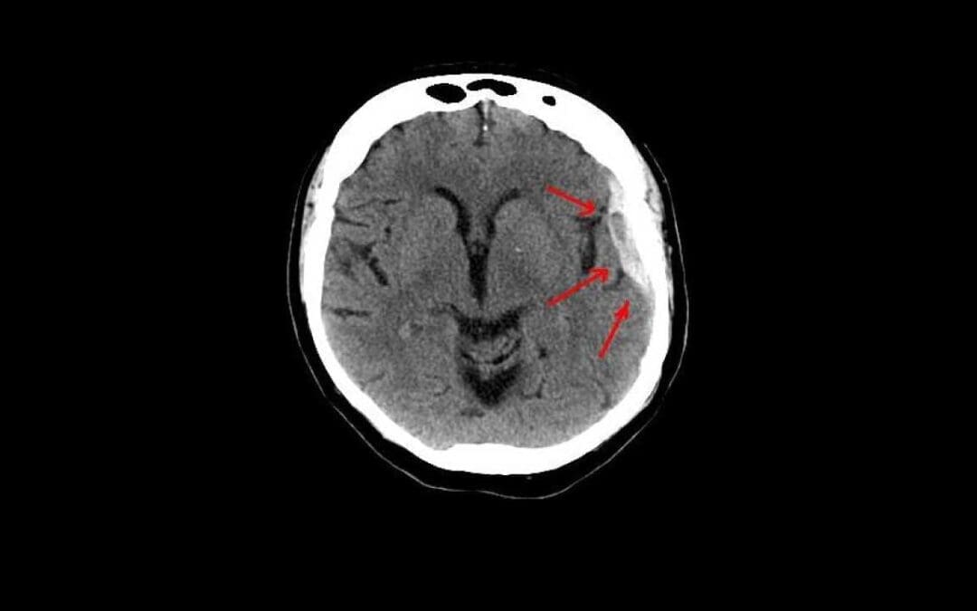 Understanding Hematoma