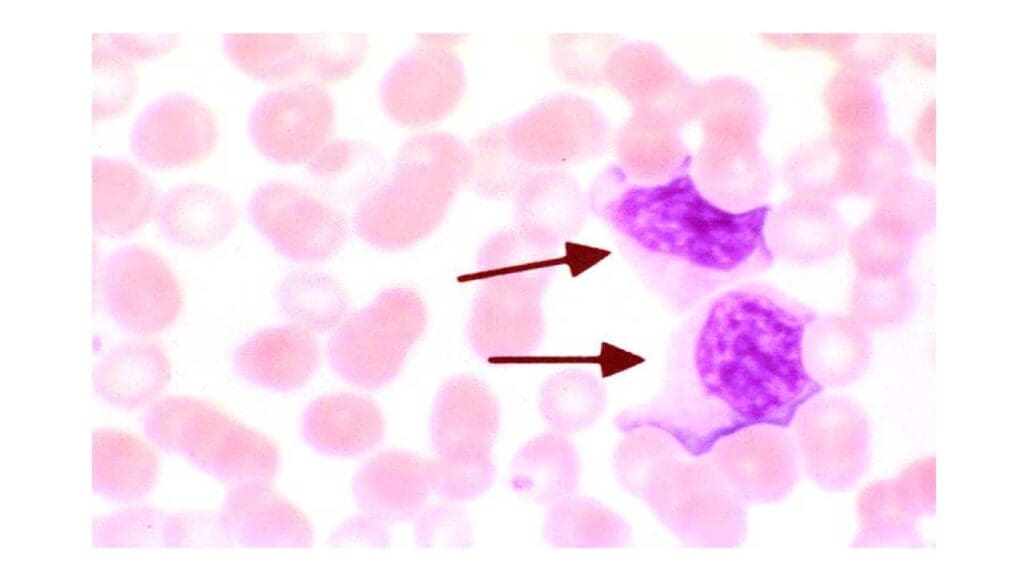 Presence of atypical lymphocytes (reactive lymphocytes) in the peripheral blood smear.