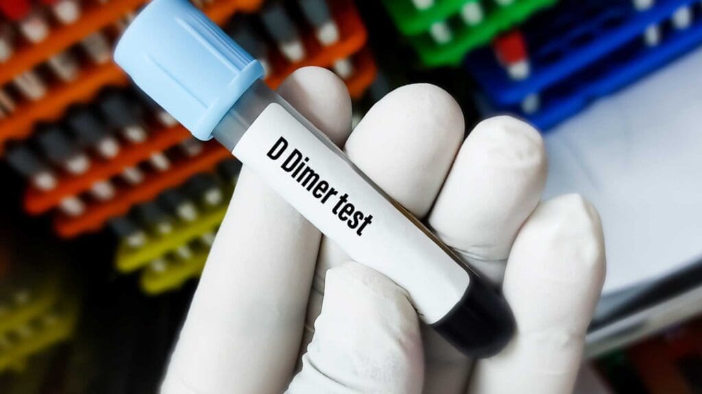 Blood sample for D-dimer test is collected in light blue top sodium citrate tube.