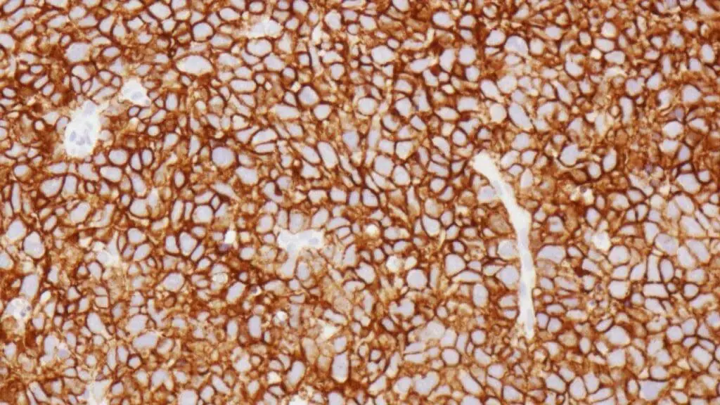 A strong positive CD20 stain confirming diffuse large B-cell lymphoma (DLBCL) in a biopsy sample.