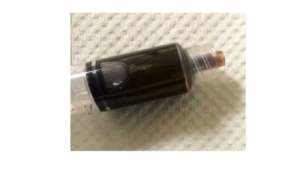 Chocolate-colored blood due to methemoglobinemia