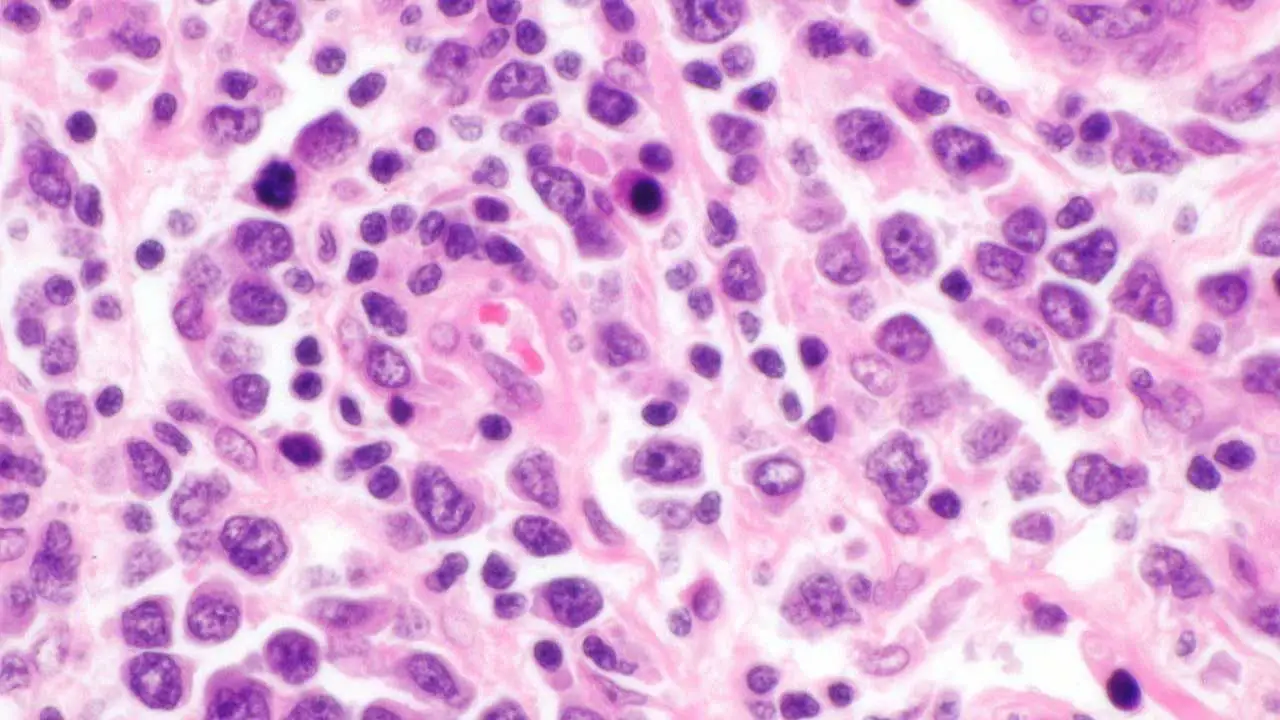 The image shows abnormal lymphocytes infiltrating the testis, a sign of diffuse large B-cell lymphoma