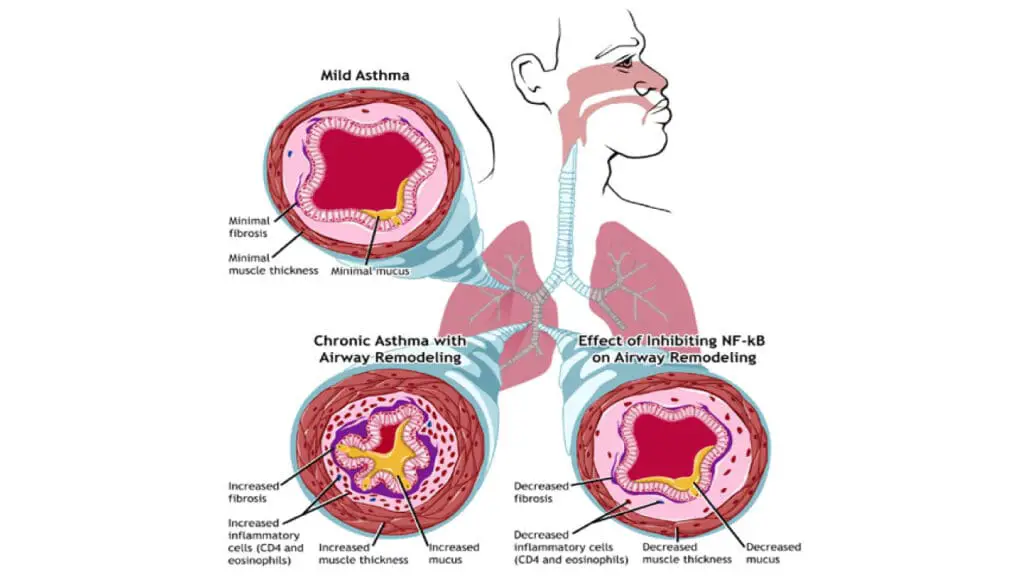In eosinophilic asthma, patients experience airway narrowing, which makes it difficult to breathe. Over time, chronic inflammation in this condition leads to airway remodeling and fibrosis, or the buildup of stiff collagen, causing irreversible changes. The signaling molecule NF-κB is a critical player in this process, and targeting it could significantly reduce the chronic inflammation and its long-term effects.