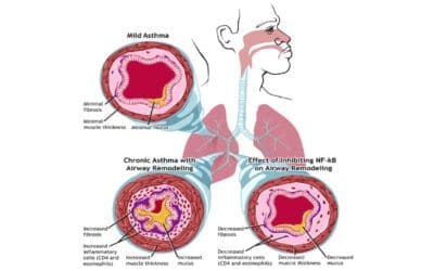 Eosinophilic Asthma