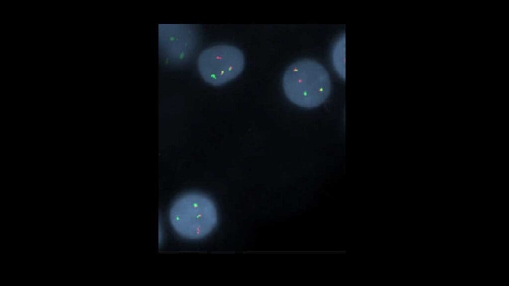 Fluorescence in situ hybridization (FISH) performed on a peripheral blood sample detected a CCND1/IGH fusion in 47% of the analyzed cell nuclei, confirming the presence of the t(11;14) translocation.