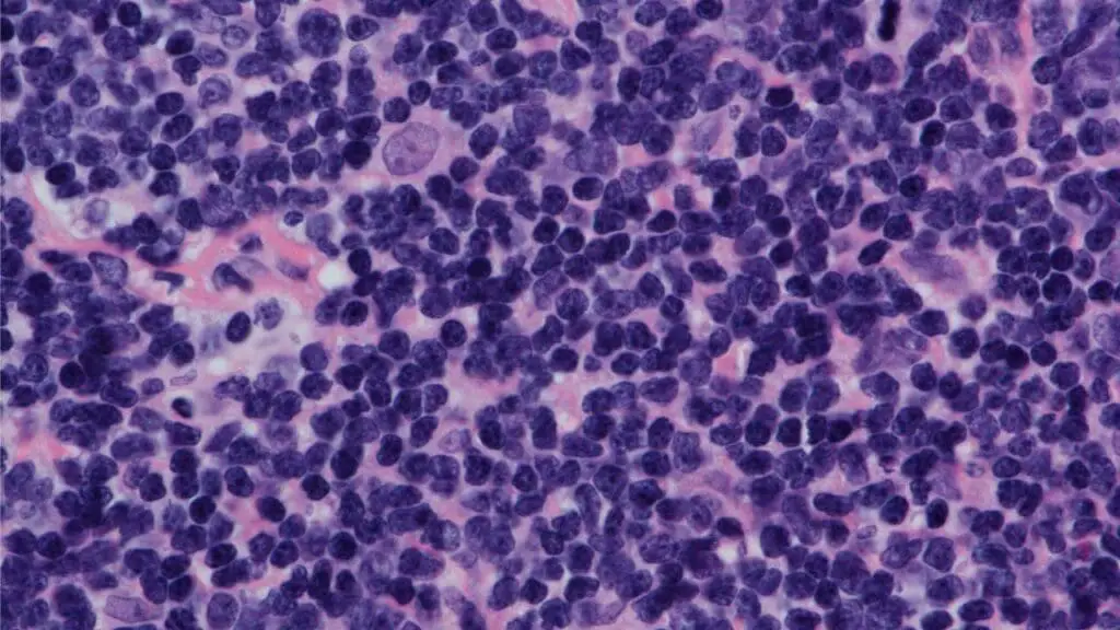 The nodular pattern of Mantle Cell Lymphoma (MCL Disease) is visible at high magnification. The lymphoma cells are of medium size and have irregular nuclear contours. A key feature is the presence of a pink histiocyte interspersed among the malignant cells. Immunohistochemical staining confirmed the diagnosis, as the lymphoma cells were positive for CD5, CD20, and cyclin D1.