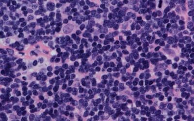 Mantle Cell Lymphoma (MCL Disease)