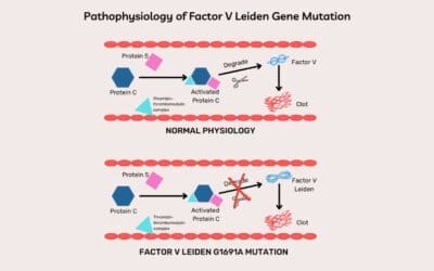 Factor V Leiden Thrombophilia