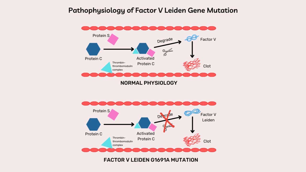 Pathophysiology of Factor V Leiden Thrombophilia.
