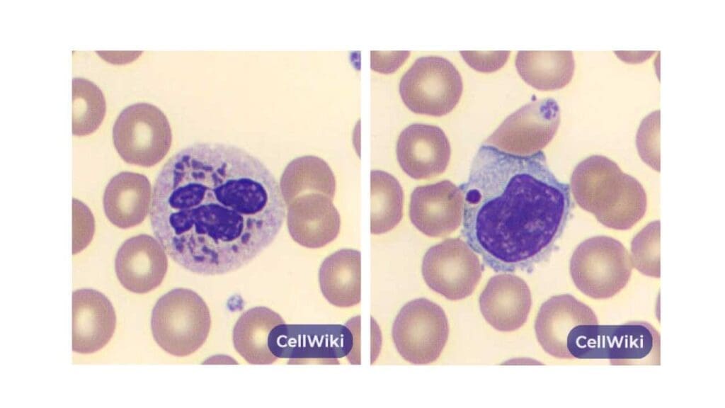 Peripheral blood smear showing large cytoplasmic granules in the neutrophil (left image) and lymphocyte (right image) seen in Chediak-Higashi syndrome.