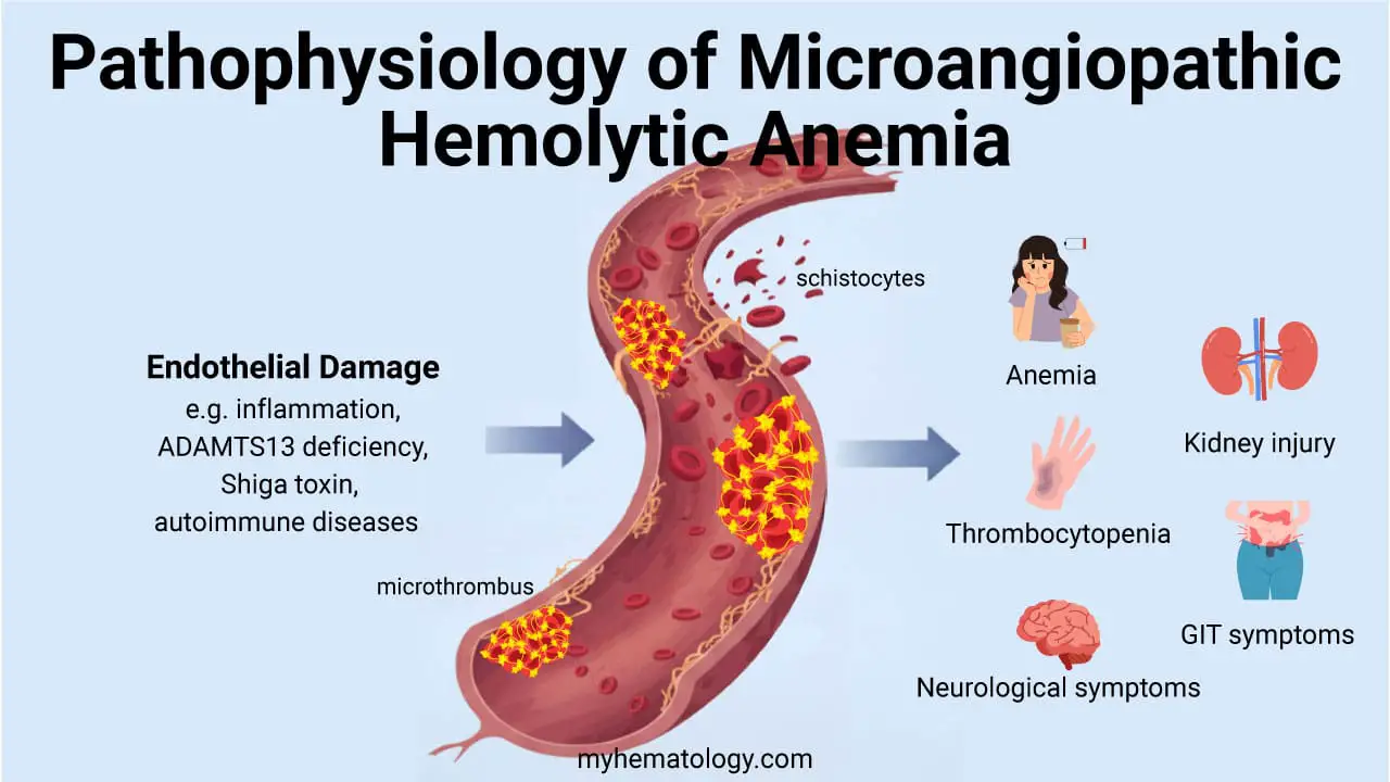 The pathophysiology of Microangiopathic Hemolytic Anemia (MAHA) begins with some form of widespread damage to the endothelium, the inner lining of small blood vessels like capillaries and arterioles. This endothelial injury triggers the formation of small, platelet-rich clots known as microthrombi within the microvasculature. As red blood cells are forced to navigate these partially or completely occluded vessels, they are subjected to immense physical shearing forces, which mechanically fragment them. This process leads to the formation of schistocytes, the characteristic fragmented red blood cells seen on a blood smear. Concurrently, the continuous formation of these microthrombi consumes the body's circulating platelets, resulting in the associated thrombocytopenia that completes the classical triad of the syndrome.