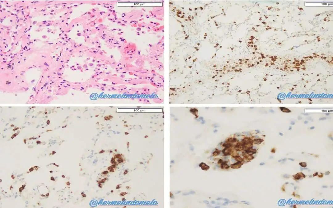 Transfusion-Related Acute Lung Injury or TRALI