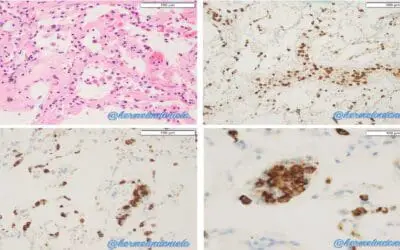Transfusion-Related Acute Lung Injury or TRALI