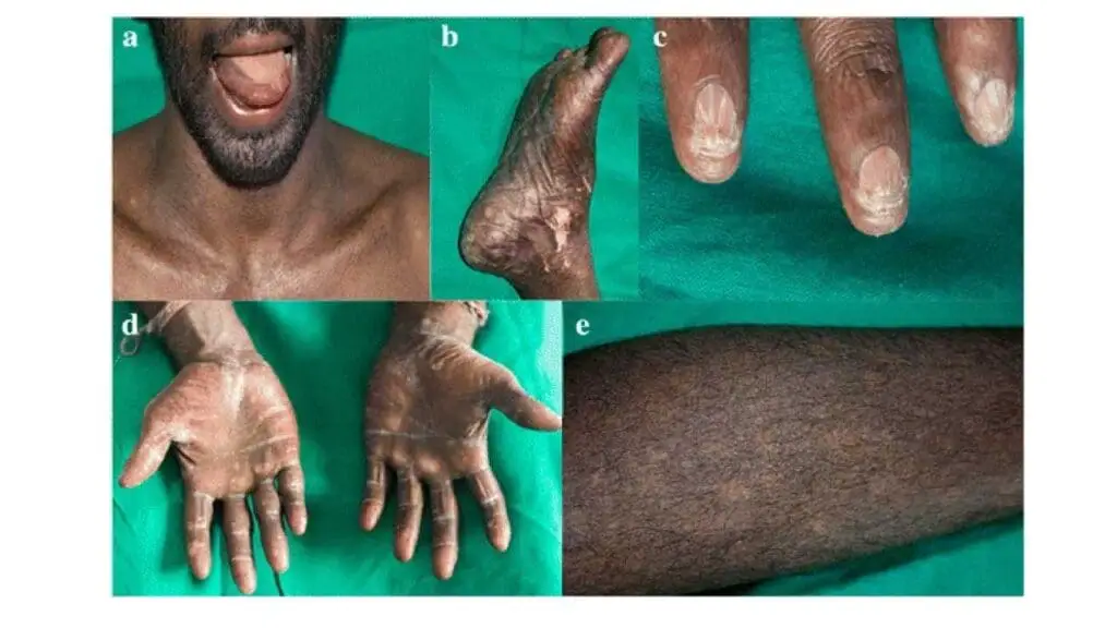 Images of an individual with dyskeratosis congenita including presentations of oral leukoplakia, abnormal skin pigmentation and nail dystrophy.