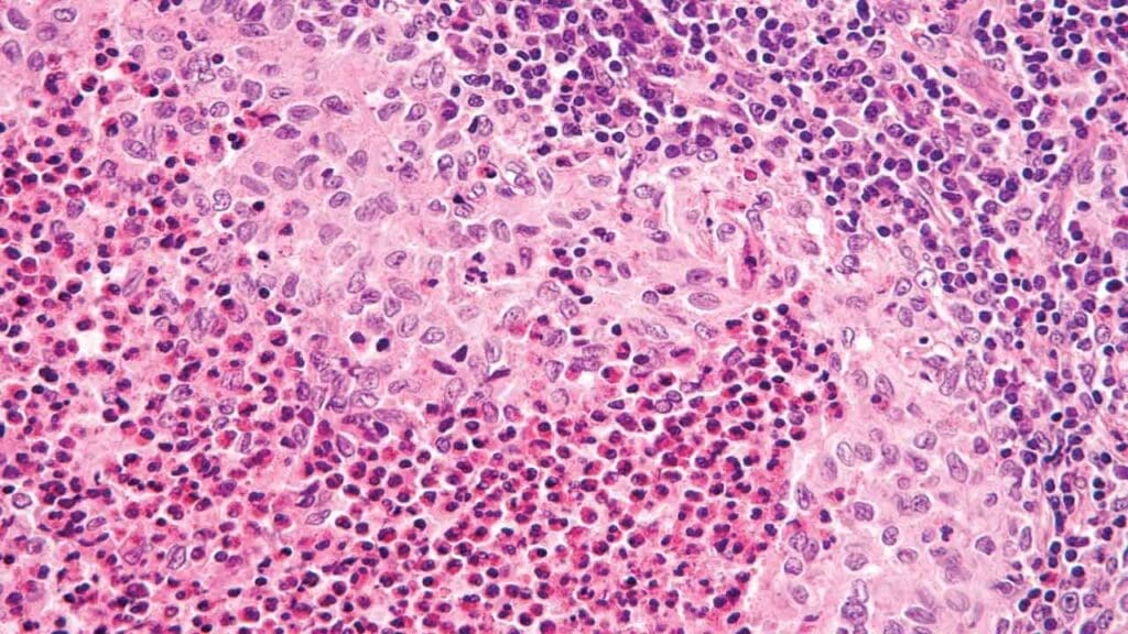This high-power microscopic view (H&E stain) illustrates the classic features of Langerhans Cell Histiocytosis (LCH). A condition historically referred to as Histiocytosis X, Hand-Schüller-Christian disease, or Abt-Letterer-Siwe disease. The hallmark of this lesion is the presence of specialized histiocytes characterized by their distinct reniform (kidney-shaped) or "coffee-bean" nuclei. Diagnosis is further supported by positive immunohistochemical staining for S100 and CD1a.
