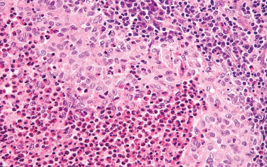 Langerhans Cell Histiocytosis (Histiocytosis X)