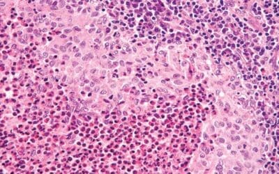 Langerhans Cell Histiocytosis (Histiocytosis X)