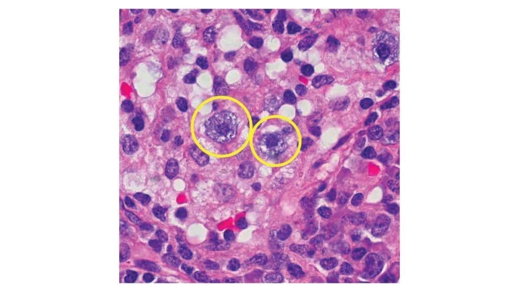 Presence of mast cells in sinus histiocytosis.