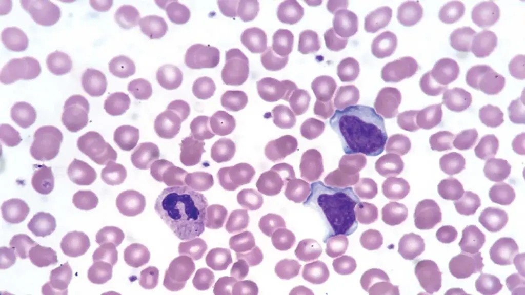 Infectious Mononucleosis. Peripheral Blood, Wright Stain