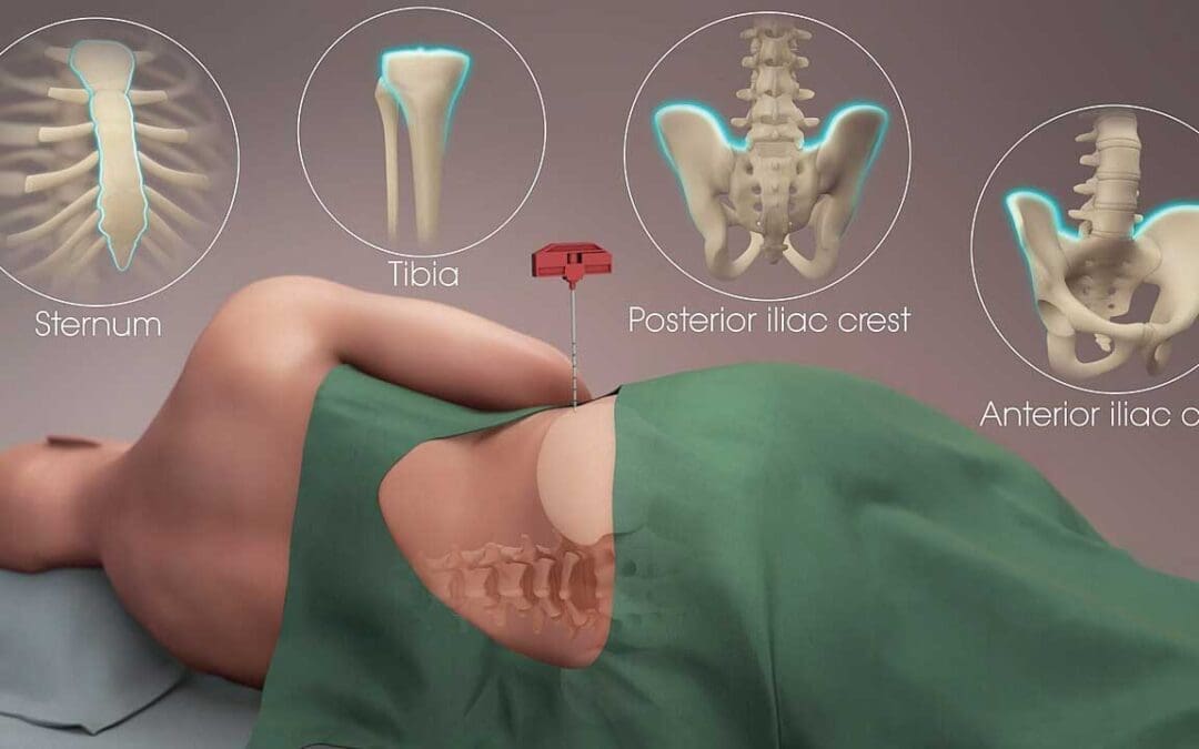 Bone Marrow Aspiration and Trephine Biopsy