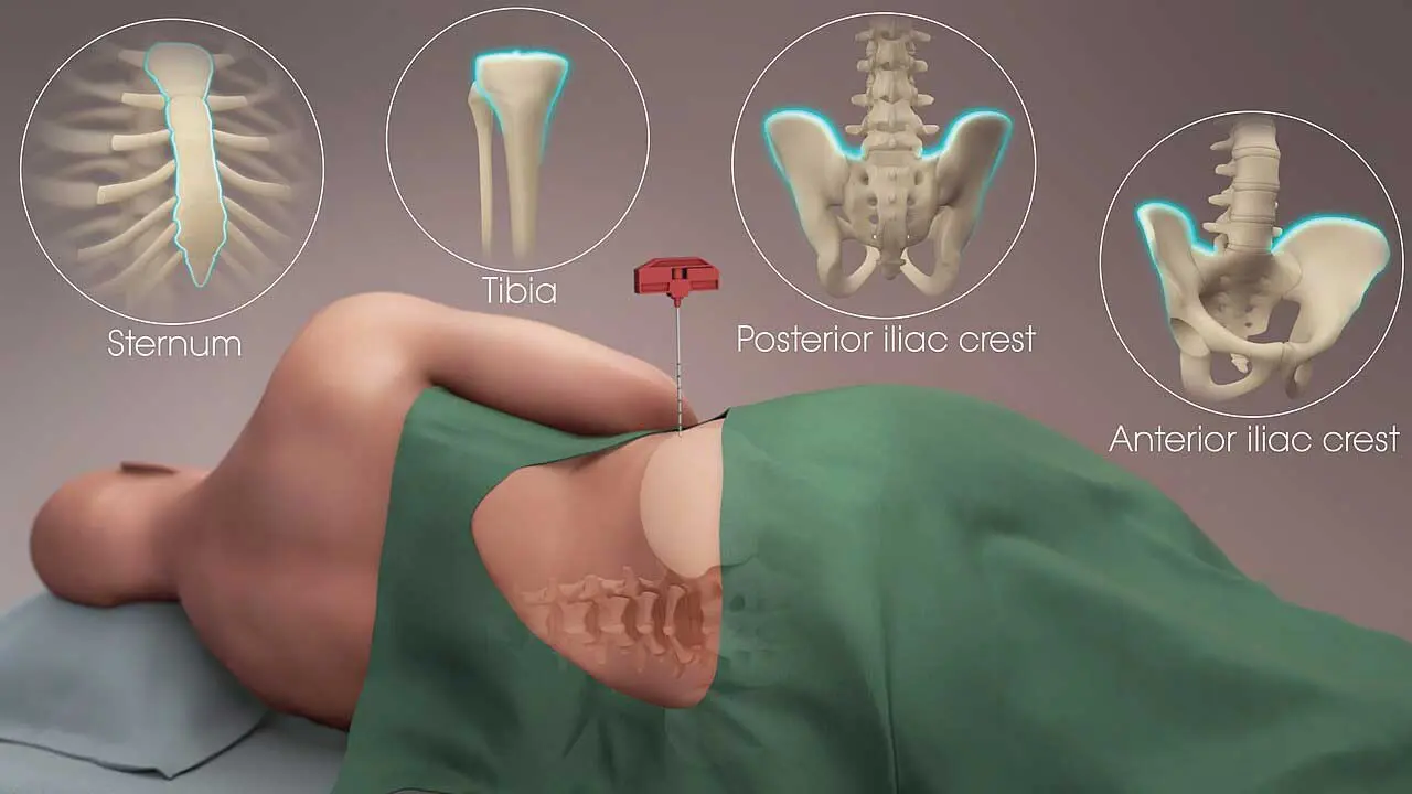 Bone Marrow Aspiration and Trephine Biopsy
